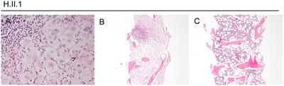 Increased Risk for Malignancies in 131 Affected CTLA4 Mutation Carriers